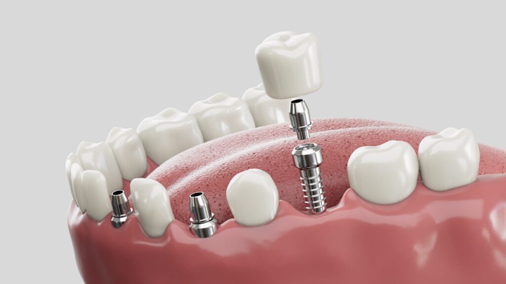 Are Dental Implants Right For You? Everything You Need To Know